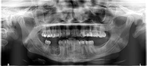 1512 best r/askdentists images on Pholder .